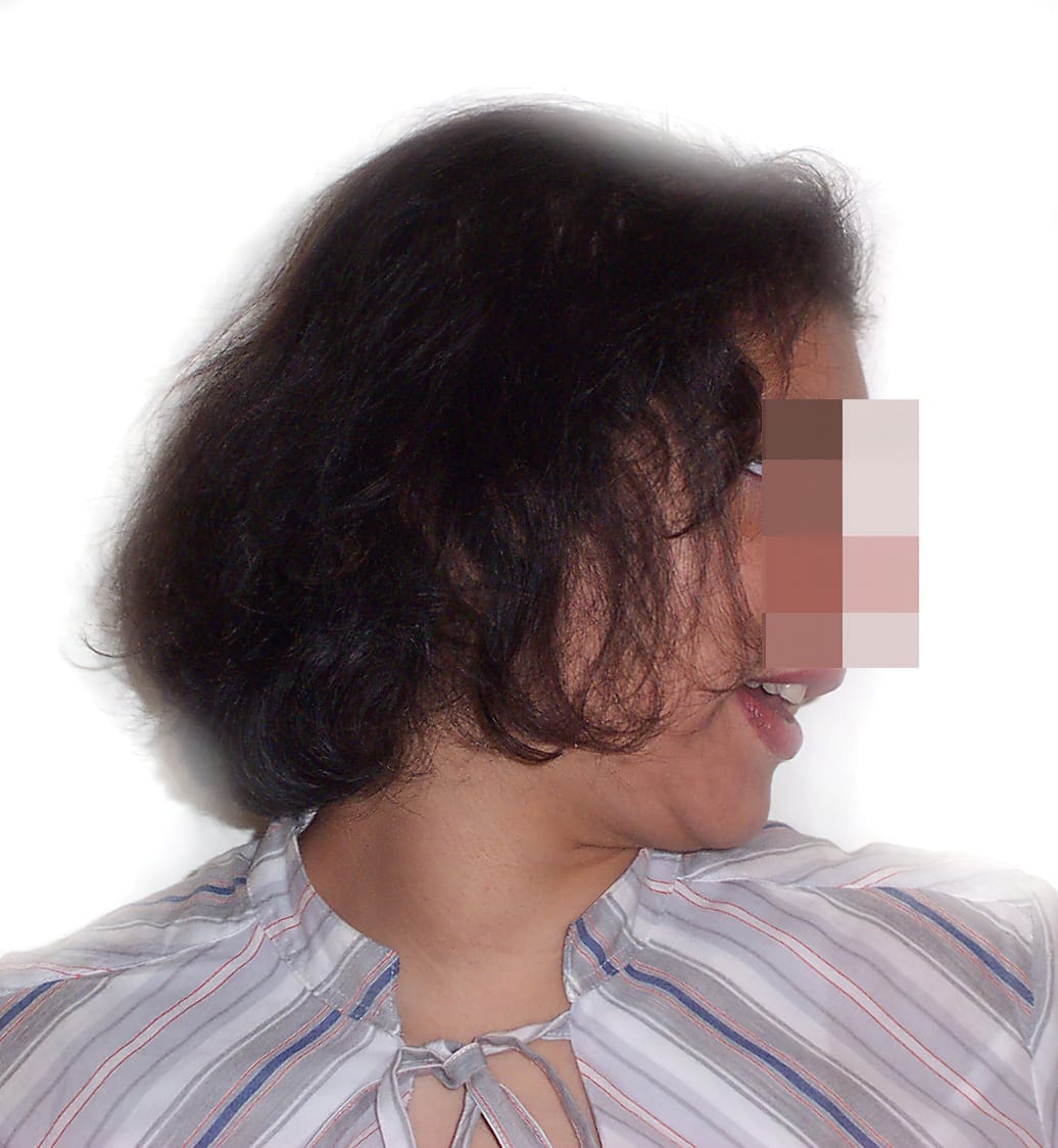Before Picture - Androgenetic Alopecia / Stress